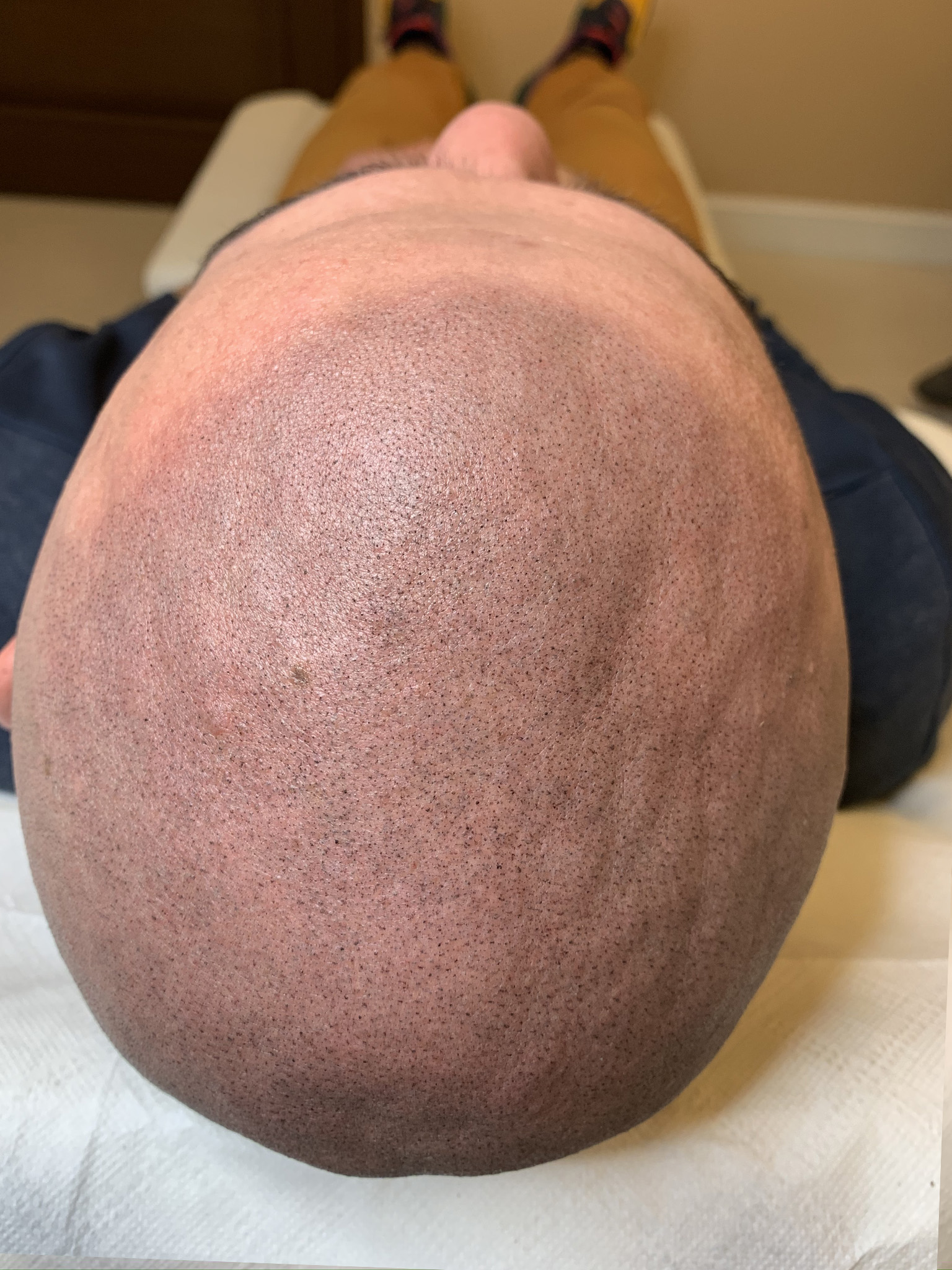 mikropigmentacja skóry głowy po zabiegu