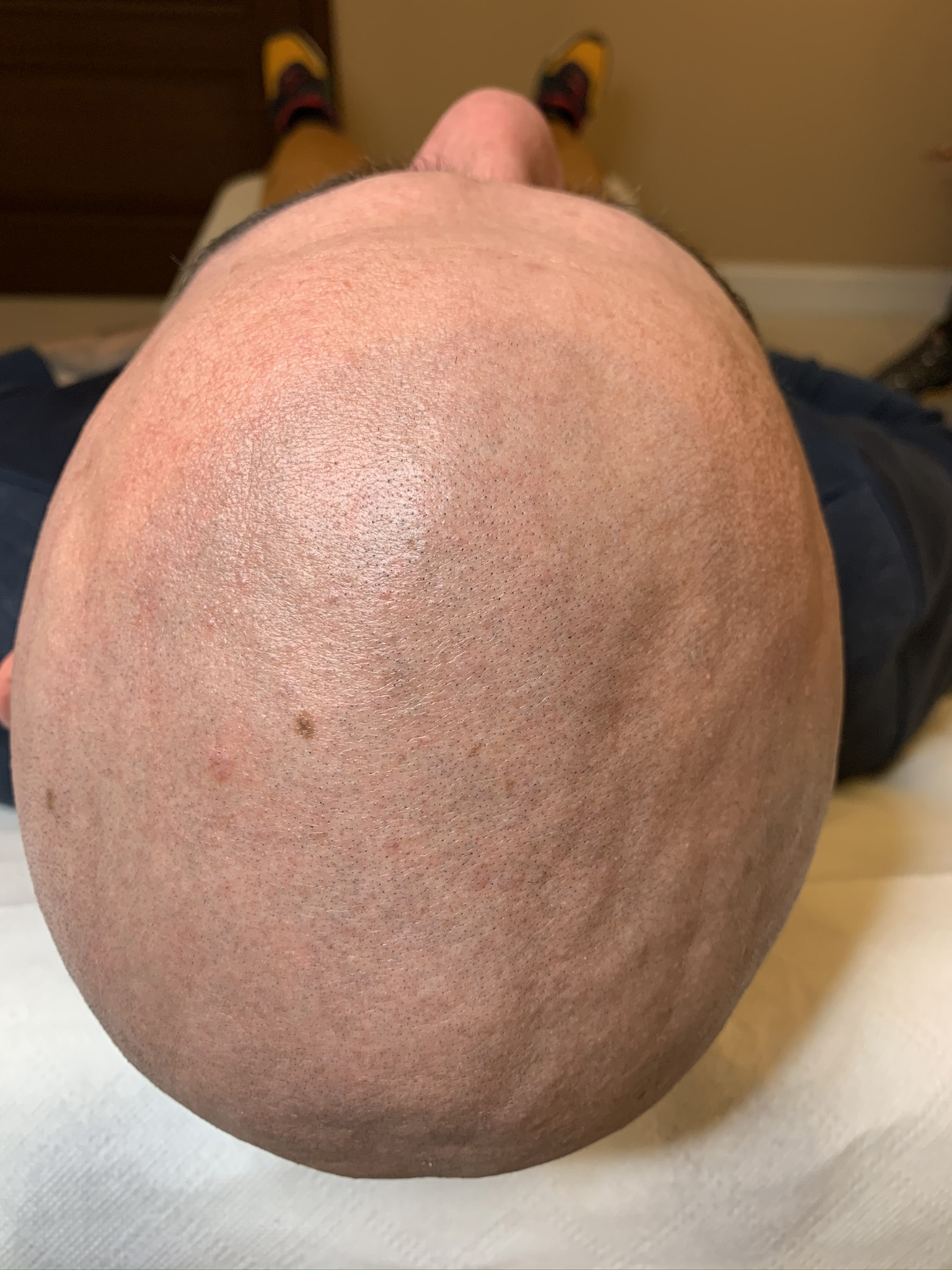 mikropigmentacja skóry głowy przed zabiegiem