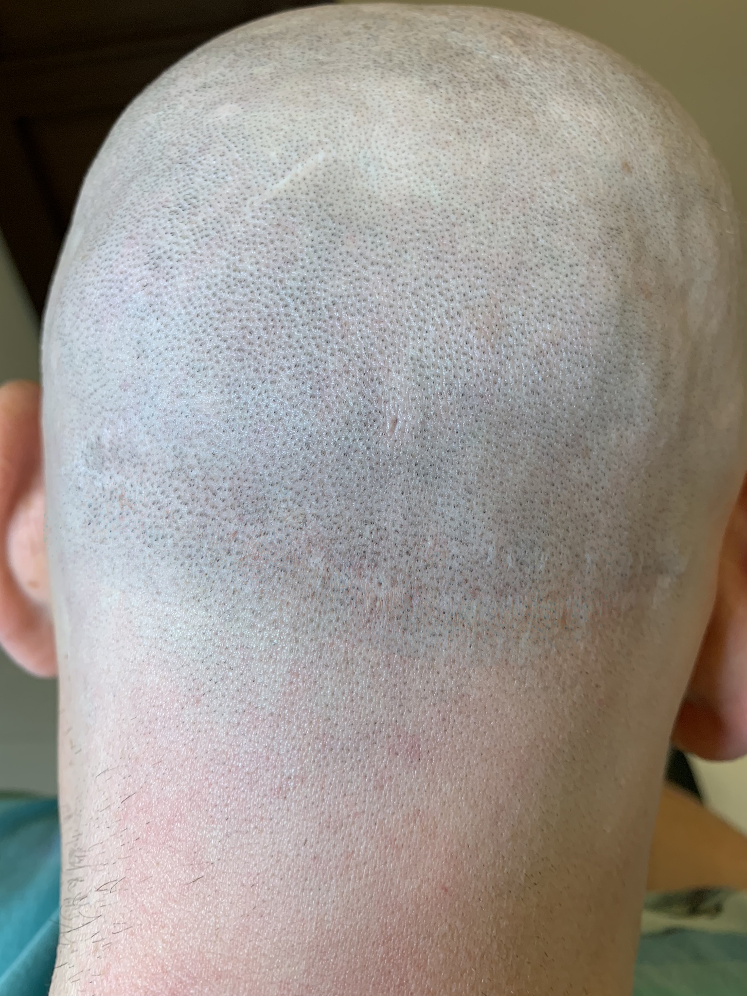 mikropigmentacja blizn skóry głowy po zabiegu