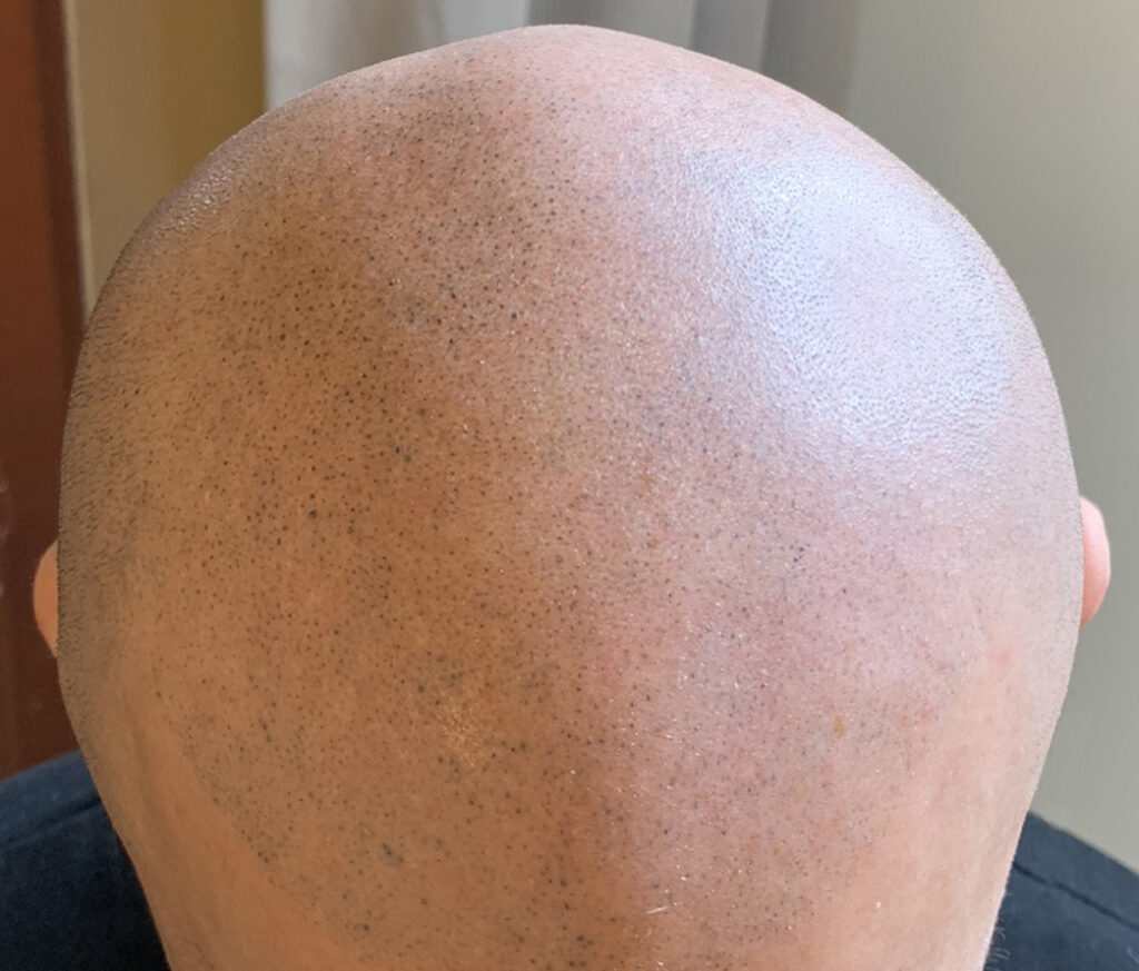 mikropigmentacja skóry głowy po nieudanym zabiegu