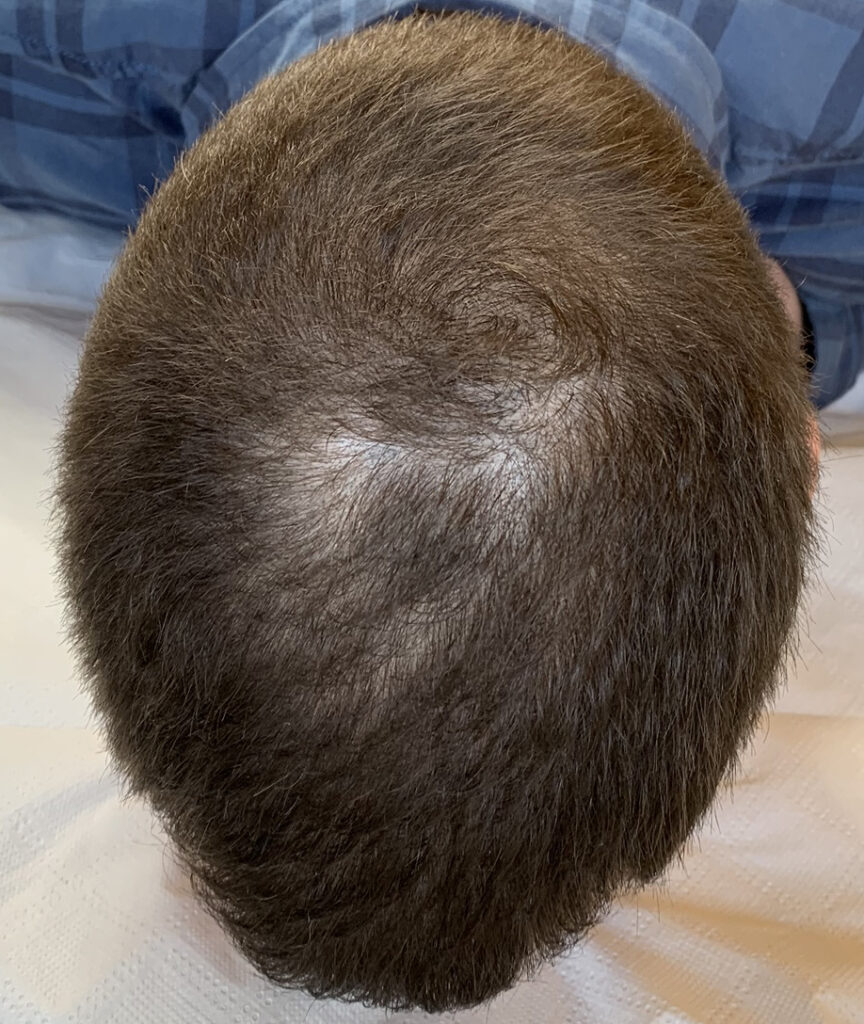 zagęszczenie rzadkich włosów metoda mikropigmentacji przed zabiegiem