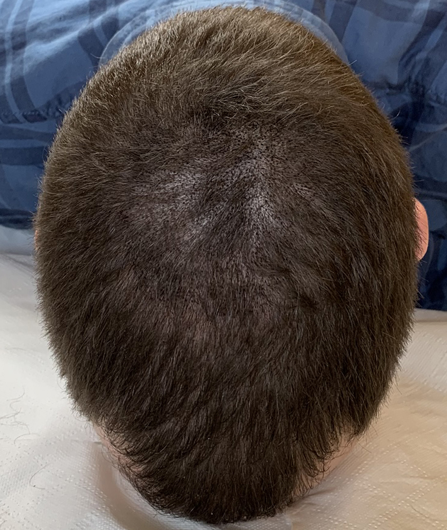 zagęszczenie rzadkich włosów metoda mikropigmentacji po zabiegu