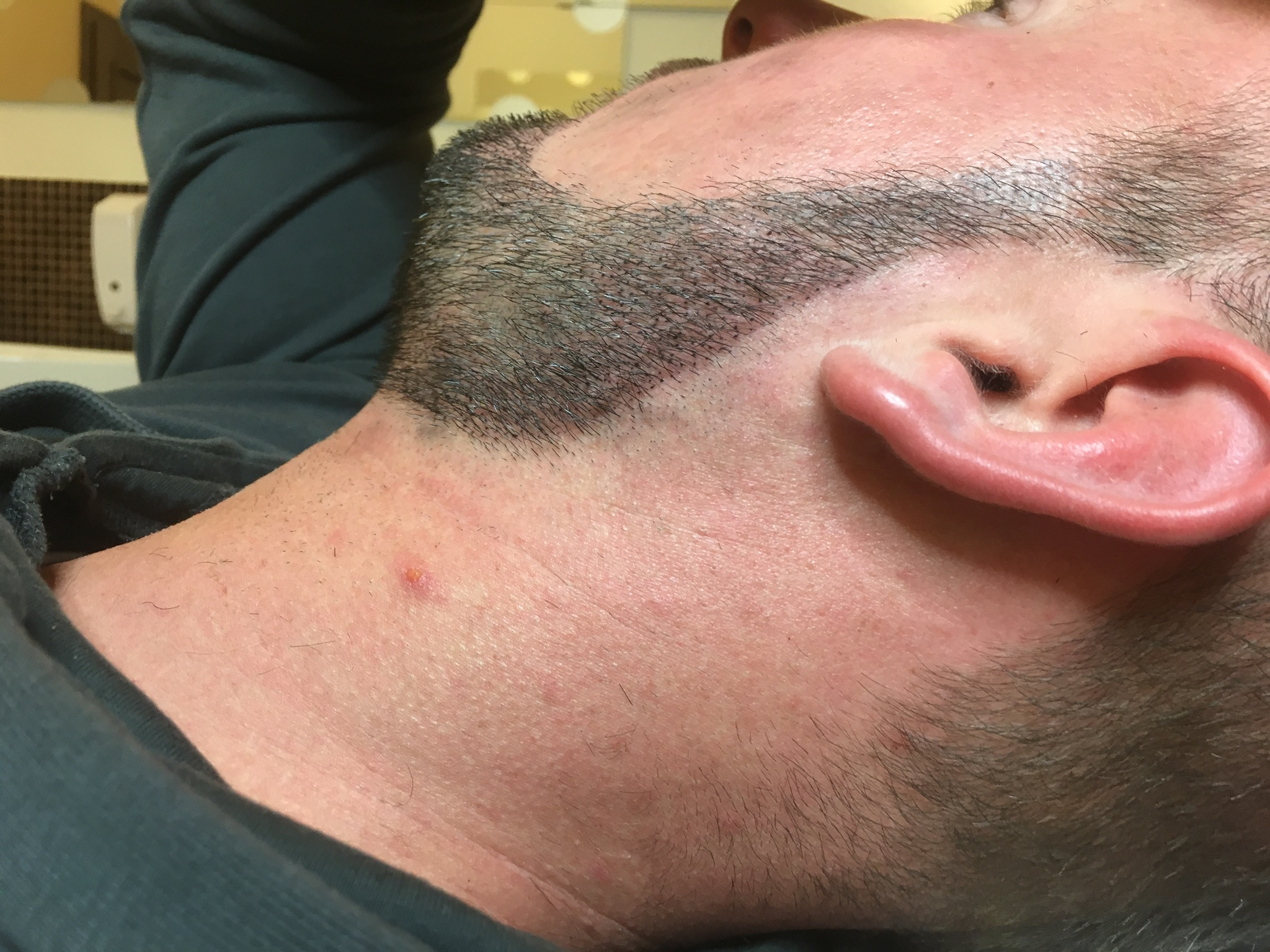 mikropigmentacja skóry brody, zarostu przed zabiegiem