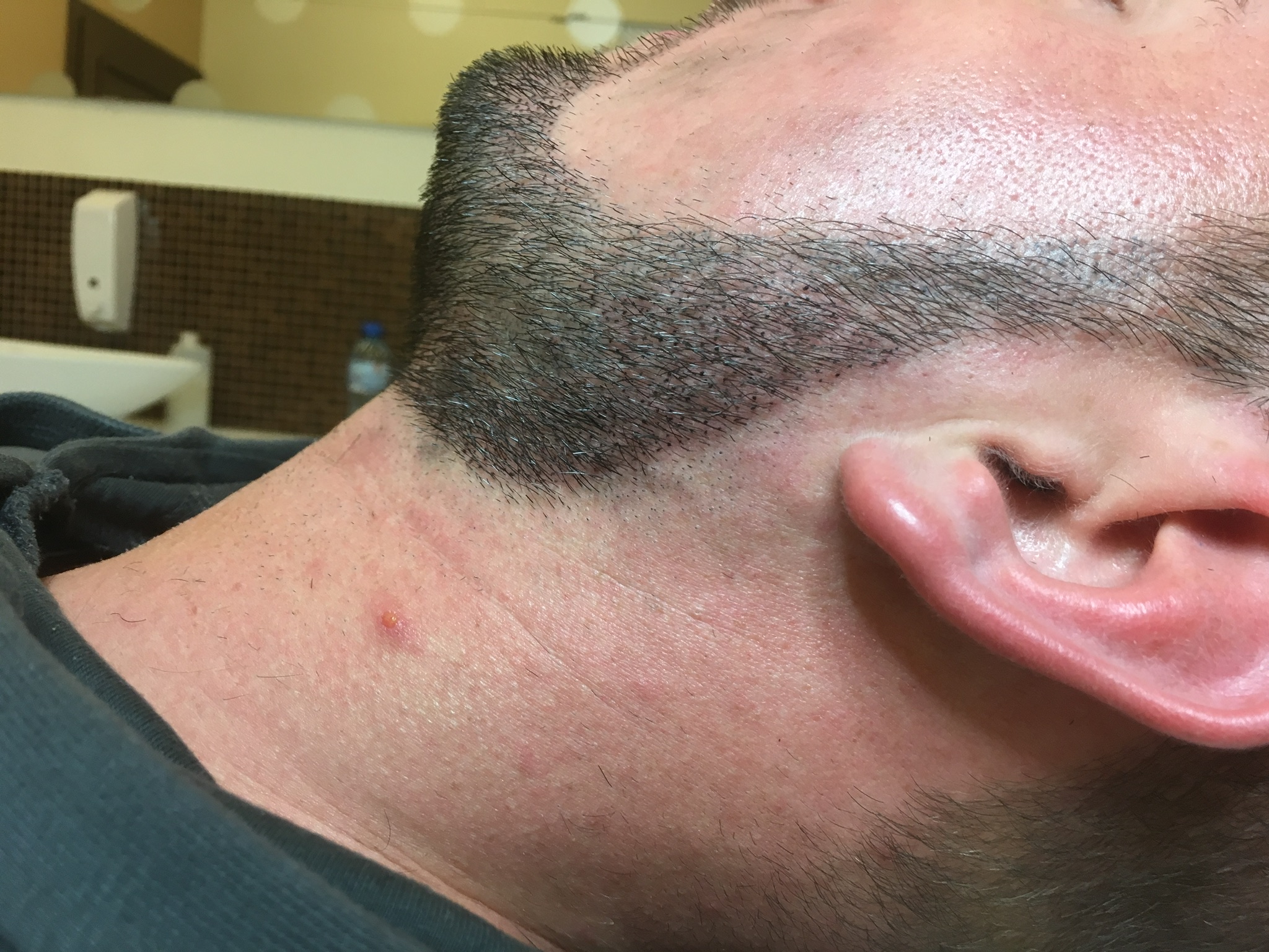mikropigmentacja skóry brody, zarostu po zabiegu