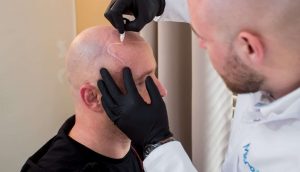 Mikropigmentacja skóry głowy – zabieg